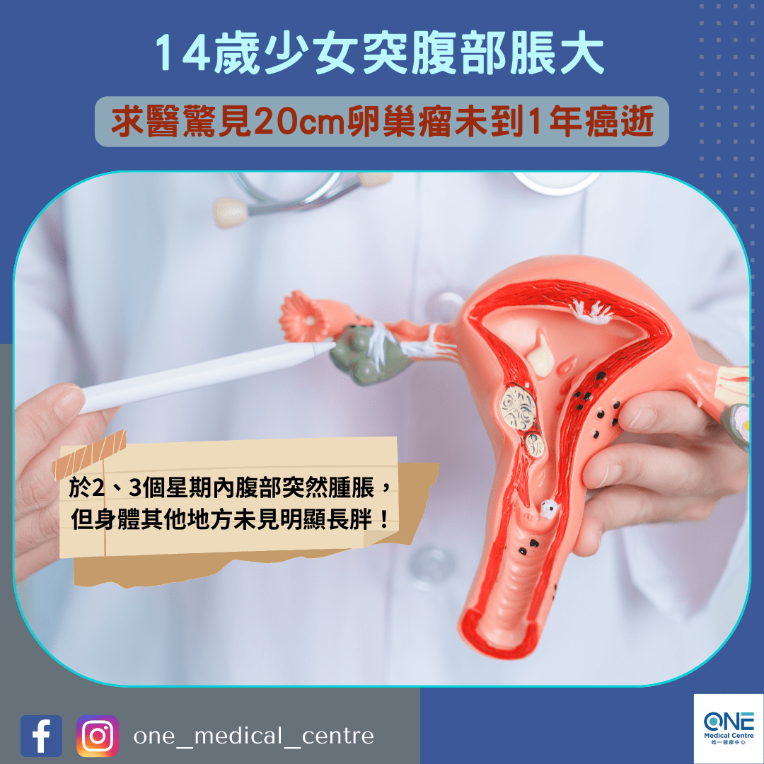 【癌症殺手 – 14歲少女突腹部脹大　求醫驚見20cm卵巢瘤未到1年癌逝】